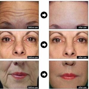 Botox Wrinkle Remover Matrixyl 3000, Argireline, Hyaluronic Acid, Face Serum 2oz