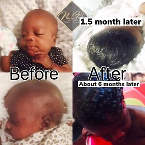 ORGANIC Children/ Baby hair Growth oil-Cradle cap, Scalp eczema, Hair Growth Oil