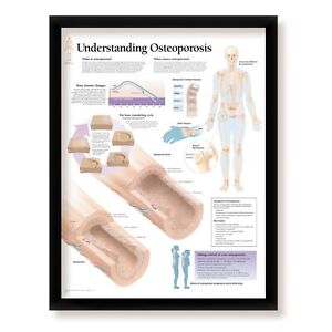 Understanding Osteoporosis Framed Medical Poster, 22x28 Wall Diagram Educational