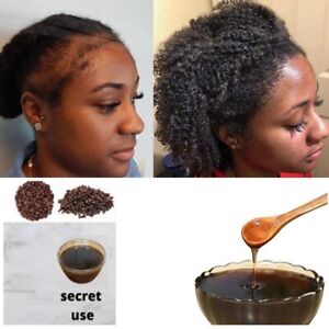 Hair Loss Treatment of Traction Alopecia Super Fast Hair Growth Shampoo 130ml