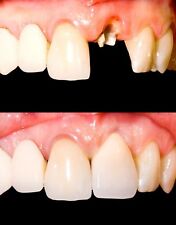 Temporary Tooth Kit x 3 Temp Dental Repair Replace Missing DIY Safe & Easy