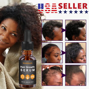 Allurium Beauty Hair Growth Serum Black Women, Anti Hair Loss Nourish Hair USA